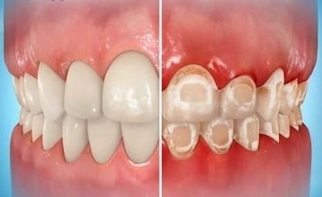 چه چیزی باعث تغییر رنگ یا لک شدن دندان ها هنگام استفاده از بریس ها می شود؟