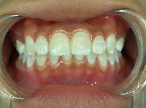چگونه از تغییر رنگ دندان ها جلوگیری کنیم؟