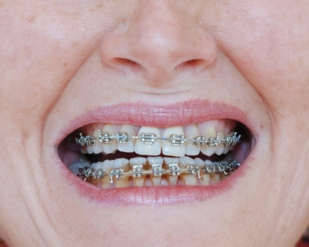 جلوگیری از تغییر رنگ و لکه دندان با بریس ارتودنسی