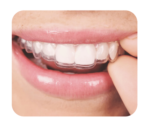 آیا می توان در طول درمان خود با الاینرهای نامرئی از محافظ دندان شبانه سفارشی استفاده کرد؟