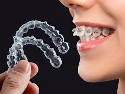 مزایای کاربرد طرح های درمان ارتودنسی هیبریدی