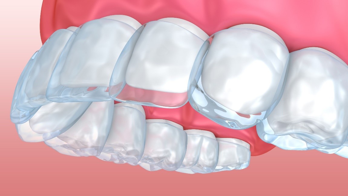 آیا می توانید برای اصلاح اورجت از الاینرهای شفاف استفاده کنید؟