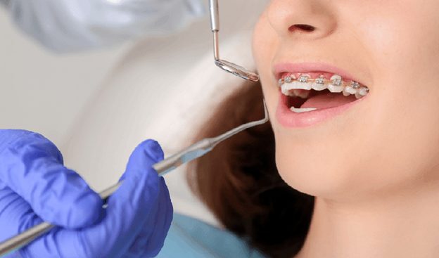 آنچه متخصصان برای برداشتن براکت ها استفاده می کنند (و چرا نمی توانید آن را در خانه تکرار کنید)