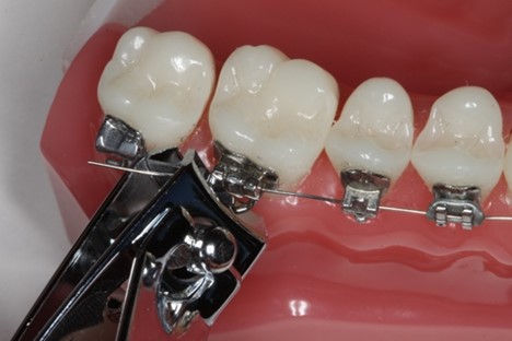 دستتان به سیم های بیرون زده ارتودنسی نمی رسد تا آنها را کوتاه کنید؟ این راه حل است!