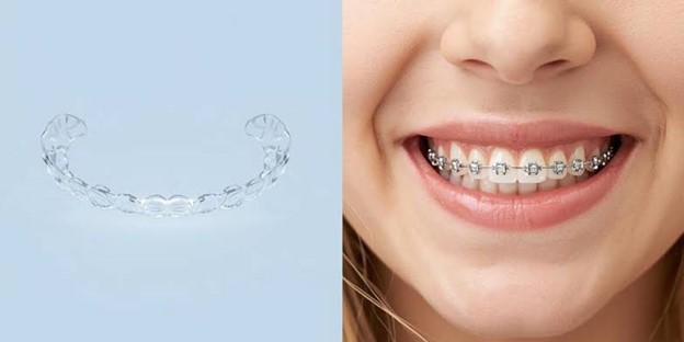 مزایا و معایب الاینرهای شفاف برای کودکان در مقایسه با بریس های سنتی